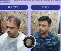 Non-Surgical Hair Replacement & Baldness Solutions in Delhi