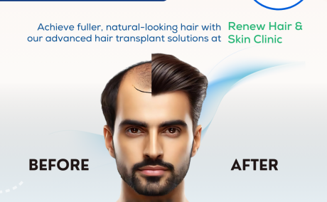 hair transplant in madurai - Renew Hair and Skin Care